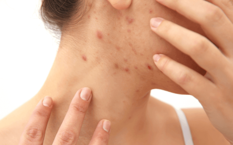 ビオチンがアトピー性皮膚炎の改善に効果がある