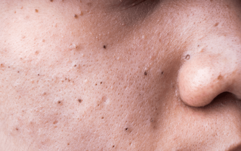 ニキビに効く抗生物質はどれ?ニキビの段階別に徹底解説! | 美容内服薬ラボットメディカルクリニック【公式】